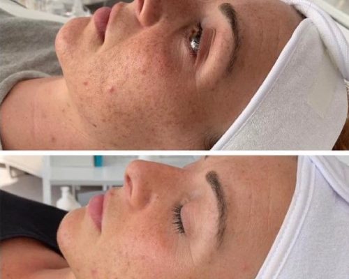 Before after face